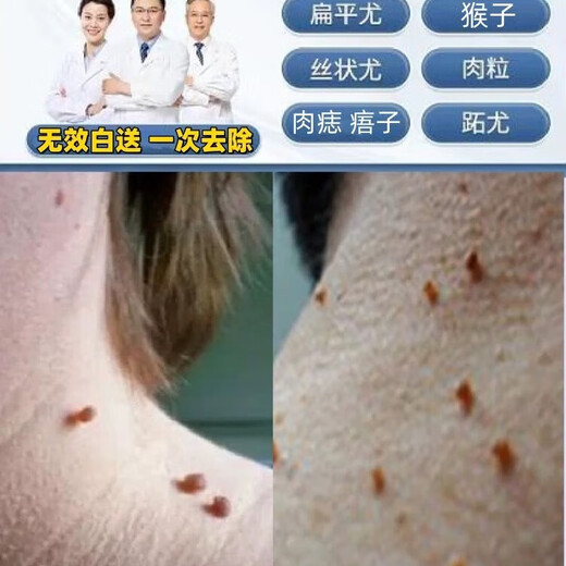 Remove small pimples on the neck, monkey black spots, filamentous thorns, plantar tags, remove flat tags, regular skin tags under the armpits