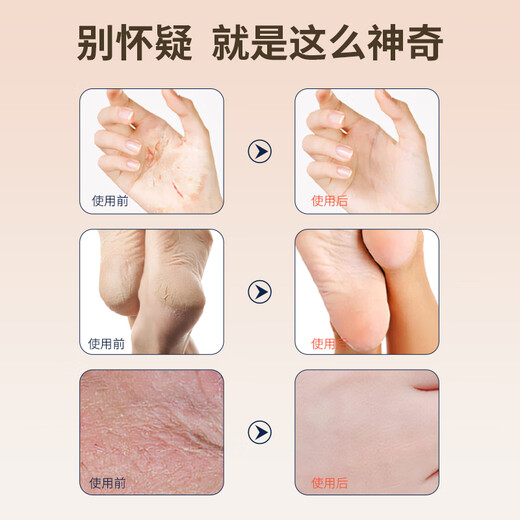 Ice King Cracked Cream 50g Cracked Foot Cream Heel Dry Cracked Peeling Hands and Feet Anti-Crack Cream Hand Cracked Skin Cracked Foot Cream