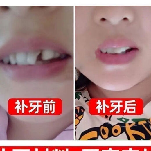 奇力康补牙材料永久医用补牙齿神器材料永久自己在家补牙材料临时补牙缝 967倍效【补15颗牙】爆丨款坚固不掉