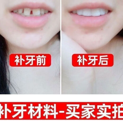 奇力康补牙材料永久医用补牙齿神器材料永久自己在家补牙材料临时补牙缝 967倍效【补15颗牙】爆丨款坚固不掉