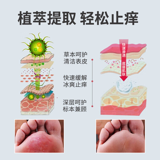 Chunchuntang Yunnan Materia Medica Athlete's Foot Spray Anti-Itchy Feet, Sweaty Feet, Itchy Feet, Peeling and Odor, Soaking Feet and Athlete's Foot Set