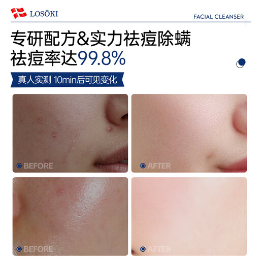 Losoki Schweizer importierter Gesichtsreiniger zur Akne- und Milbenentfernung, Aminosäureöl für Männer und Frauen, Kontrolle von Akneflecken, Mitesser, Porenverschlussreiniger, Milben- und Akneentfernung, Gesichtsreiniger, 200 ml*1