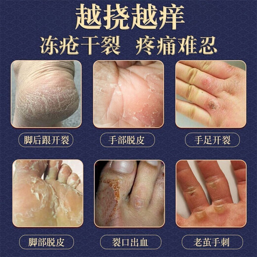 Tong Ren Tang Moisturizing Cracked Feet Cream, Cracked Hands, Cracked Heels Cream, Anti-freeze and Anti-Crack Cream, Cracked Feet Peeling Cream, 1 Bottle, Nourishing and Moisturizing Cream