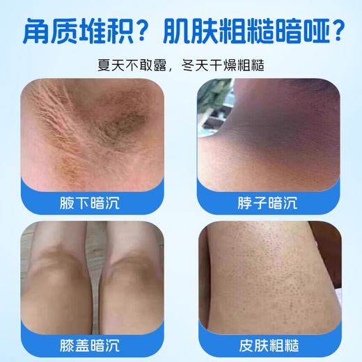 Sakose Vaseline Vitamin A Acid Cream + Vitamin E Urea Cream Fruit Acid Combination Relieves Dry and Peeling Chicken Skin and Refreshes it