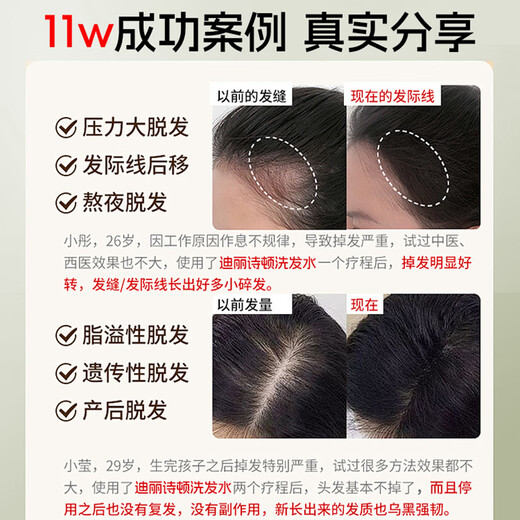 Deliston anti-hair loss shampoo, ginger king, hair growth, anti-hair loss, oil control, fluffy herbal hair-fixing and long-hair growth