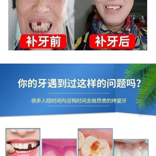 奇力康补牙材料永久医用补牙齿神器材料永久自己在家补牙材料临时补牙缝 967倍效【补15颗牙】爆丨款坚固不掉