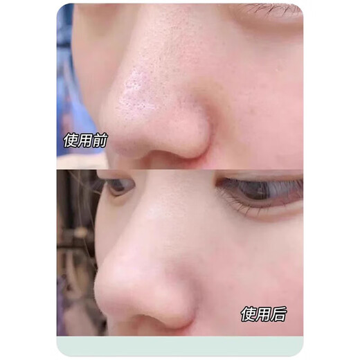 Scrape away blackheads. Portable blackhead scraper. Manual acne facial cleansing hair follicles and pores. Blackhead spatula scraper. Small blackhead spatula for face shaving. Portable 2 pack. Scrape away blackheads + bid farewell to strawberry nose. Mini beauty spatula.