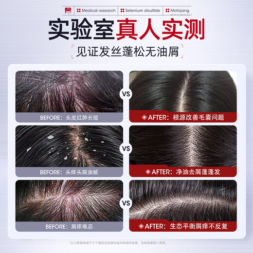 Three Magic Hairmasters Selenium Disulfide Shampoo Oil Control Anti-dandruff 400ml Powerful Cleaning Oil Control Fluffy Acne Clearance Shampoo

