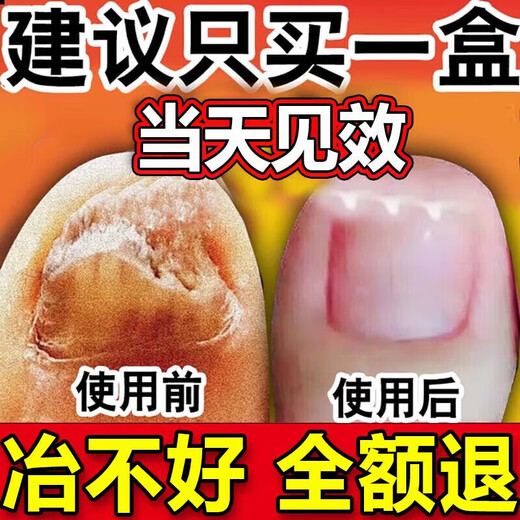 The No. 1 drug for onychomycosis in Hong Kong’s large pharmacy, dedicated for onychomycosis, fungal infection, removal of onychomycosis, new brightening of nail roots, antibacterial solution, 1 box, 1-2 recommendations