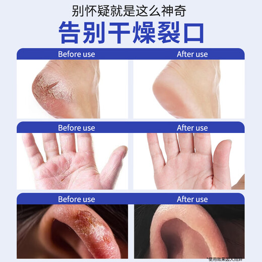 Lishikan Cracked Cream Cracked Heels Hand Cream Prevents Cracked Heels Repairs Cracked Fingers Frost-Cracked Ear Sores Cream