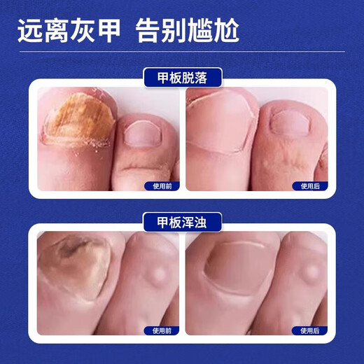 Hong Kong Pharmacy Co., Ltd. special onychomycosis removal, thickening, yellowing and emptying of onychomycosis, suitable for onychomycosis, Chinese herbal water antibacterial solution 30ml