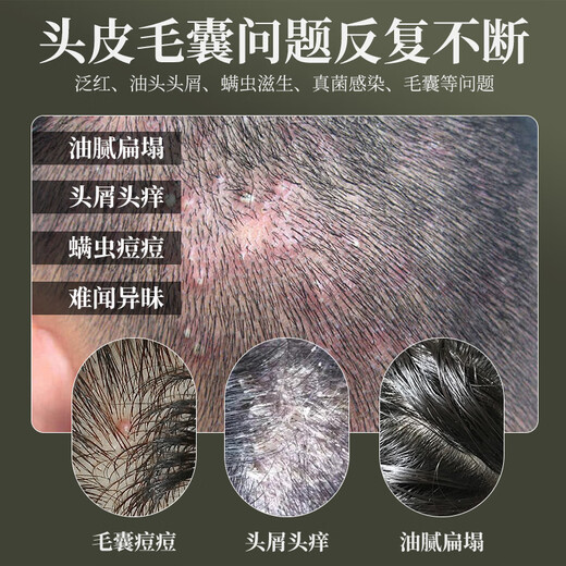 HIEUAILR German brand hair follicle cleaning shampoo anti-dandruff anti-itchi control oil fluffy mites remover men and women long-lasting fragrance cleaning cream [three bottles consolidation package] Deep cleaning farewell to mites acne