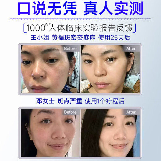 Lark 377 Whitening and Freckle Removal Cream Freckle Removal Whitening and Lightening Melanin Remove Freckles and Melasma for men and women