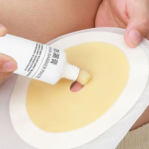 Kanglebao-Stoma-Leck-Sof-Paste ohne Alkohol Leckage Kleber Füllung Das Fistel Gap Stoma-Chassis ersetzt Leckage-Sof-Patch-Ring 12050 Gleiches Modell [Inland Ersatz Kanglebao] Stoma-Leck-Soach-Paste [1 Box] Erfahrungspaket