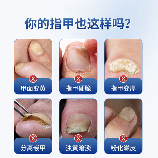 The No. 1 drug for onychomycosis in Hong Kong’s large pharmacy, dedicated for onychomycosis, fungal infection, removal of onychomycosis, new brightening of nail roots, antibacterial solution, 1 box, 1-2 recommendations