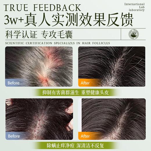 HIEUAILR шампунь для волосяных фолликулов с салициловой кислотой, против перхоти, против зуда, для контроля жирности, пушистый золотой список № 1, шампунь для удаления масла длительного действия