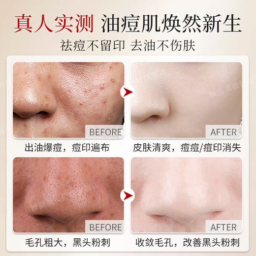 倾龄硫磺洗面奶深层清洁毛孔控油除螨沐浴露去黑头祛痘净颜男士洁面乳 三支装更实惠【清洁黑头粉刺闭口】