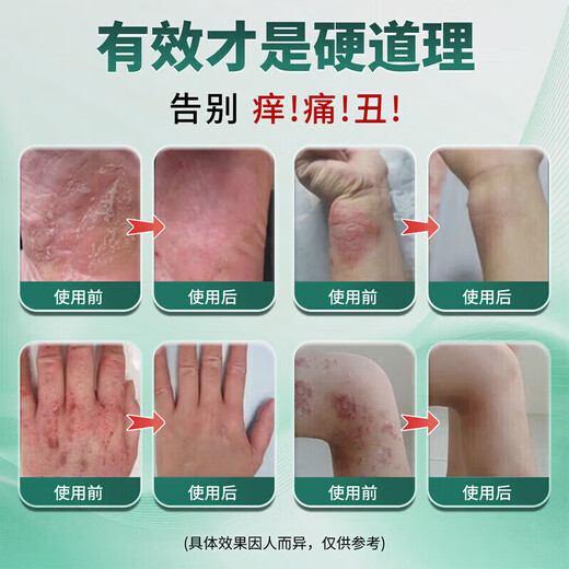 Tongrentang eczema anti-itch skin itching body itching anti-itch dermatitis eczema fungus scrotum moist thigh itching spray cream