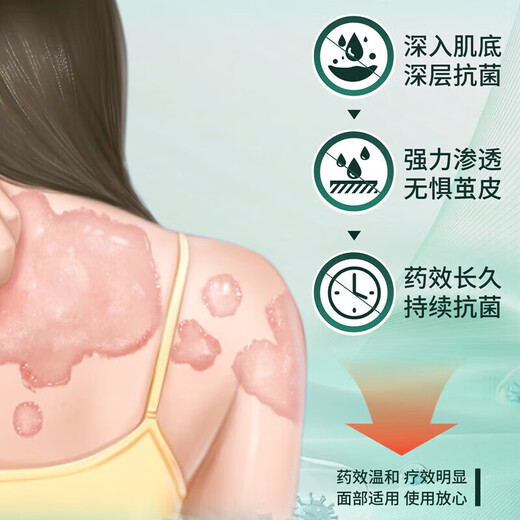 Tongrentang eczema anti-itch skin itching body itching anti-itch dermatitis eczema fungus scrotum moist thigh itching spray cream