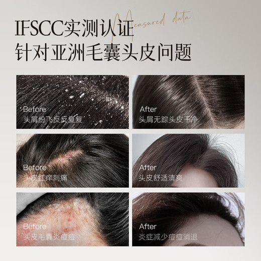 Allowish folliculitis shampoo 300ml anti-dandruff anti-itching oil control long-lasting fluffy anti-hair loss shampoo imported