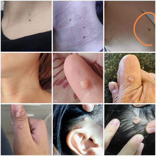 Remove small pimples on the neck, monkey black spots, filamentous thorns, plantar tags, remove flat tags, regular skin tags under the armpits