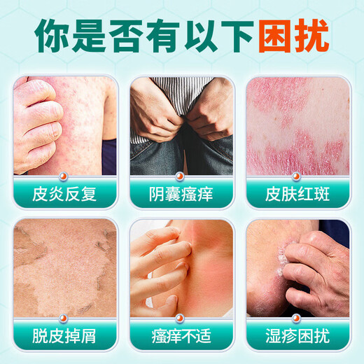 Tongrentang eczema anti-itch skin itching body itching anti-itch dermatitis eczema fungus scrotum moist thigh itching spray cream