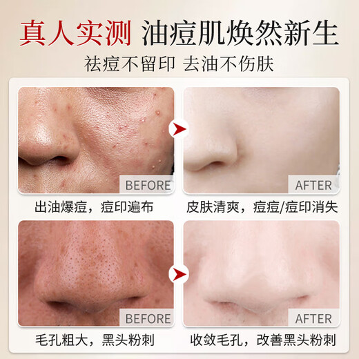 Cleanser facial Drar Sulphur, embellecer, limpieza suave, limpieza de suero, Blackhead encoge los poros y controla el aceite para hombres y mujeres 2 botellas [limpieza diaria y control del aceite]