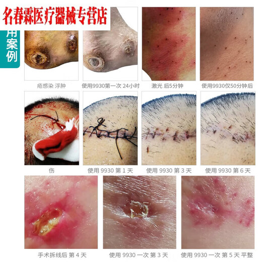 
9930 Medical wound disinfectant burn scald trauma surgery household non-alcoholic disinfection anti-infection spray Old style