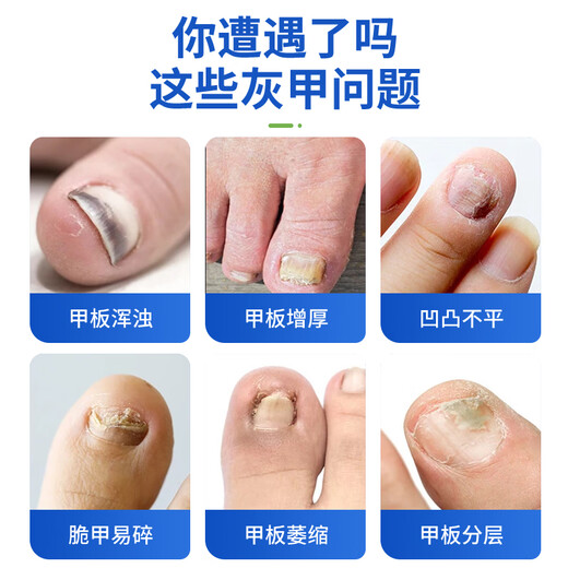 Correct impatiens onychomycosis antibacterial liquid, thick nails, bad nails, empty nails, yellowing, atrophy, discoloration, thickening and turbidity, fungal infection, impatiens onychomycosis antibacterial liquid 1 bottle