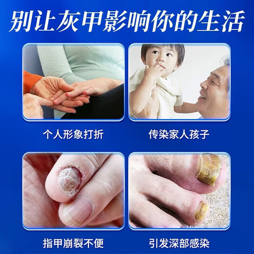 Baiyunshan Huacheng Onychomycosis 100% special effect medicine for nail fungal infection, removal of onychomycosis, thickening of onychomycosis, antibacterial potion, special effect 3 boxes, 90% selection, 2 get 1 free