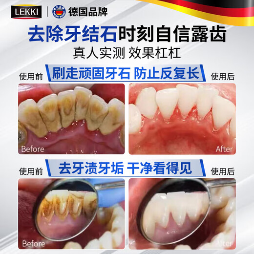 Sunoyar去牙结石牙膏口臭去黄去牙渍去烟渍牙垢清除牙结石溶解液护龈固齿