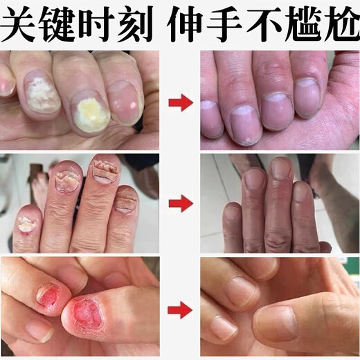 DR.JOINTNA Pharmaceutical onychomycosis special nail fungal infection denaturation and bad nail yellowing and thickening special effect nail artifact liquid phoenix flower
