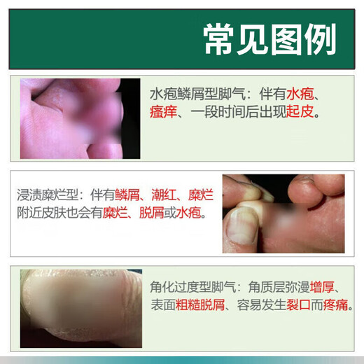 Yunnan herbal athlete's foot spray, anti-itching, peeling, rotten feet, fungal infection, blister, foot odor, sweat, antibacterial spray, 2 bottles - 60ml athlete's foot spray