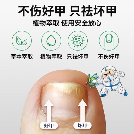 Yunnan Herbal Impatiens for Onychomycosis Antibacterial Onychomycosis Liquid Thickening, Yellowing and Empty Onychomycosis Special Effect Kit