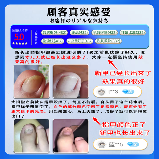 Higashida Japanese onychomycosis 100% genuine special fungal infection onychomycosis thickening, yellowing, thickening and empty 2 boxes suitable for moderate onychomycosis
