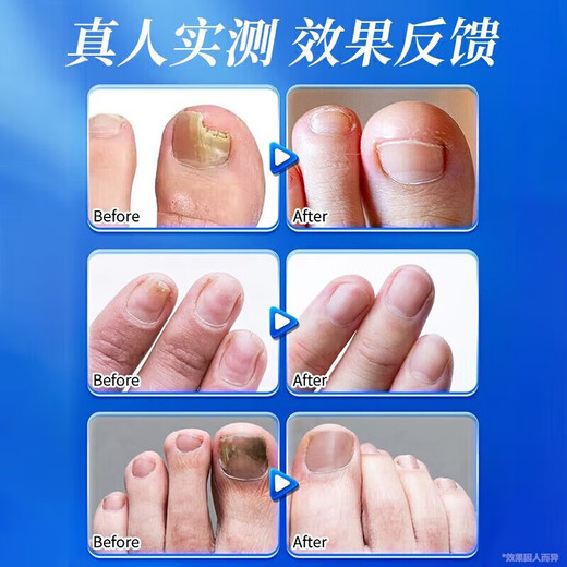 Baiyunshan Huacheng Onychomycosis 100% special effect medicine for nail fungal infection, removal of onychomycosis, thickening of onychomycosis, antibacterial potion, special effect 3 boxes, 90% selection, 2 get 1 free
