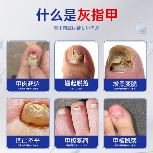 Japanese onychomycosis 100% effective special medicine. Severe onychomycosis imported fungal infection, bad nails turn yellow and thicken. Japanese special onychomycosis liquid 1 box, mildly suitable. No. 1 medicine onychomycosis 100% effective.