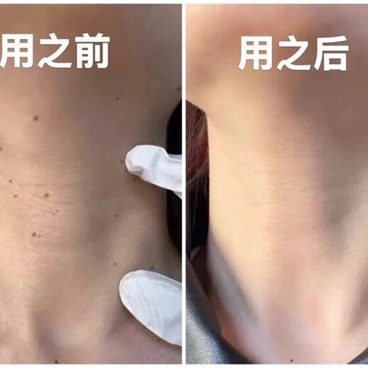 Remove small pimples on the neck, monkey black spots, filamentous thorns, plantar tags, remove flat tags, regular skin tags under the armpits
