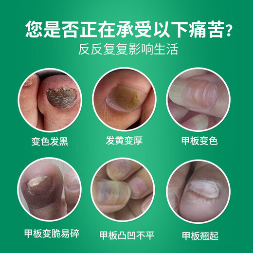 Yunnan Herbal Impatiens for Onychomycosis Antibacterial Onychomycosis Liquid Thickening, Yellowing and Empty Onychomycosis Special Effect Kit