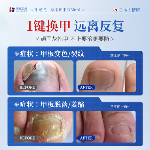Xizi onychomycosis special effect root cream is specially used to treat nail fungal infection, remove the nail, make it yellow, thicken and thicken the antibacterial liquid.