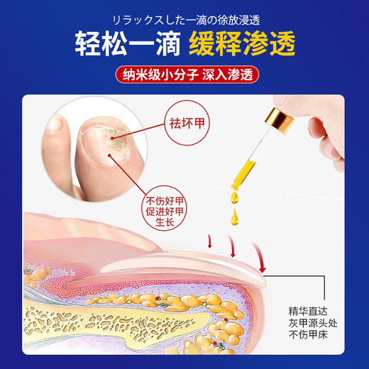 Higashida Japanese onychomycosis 100% genuine special fungal infection onychomycosis thickening, yellowing, thickening and empty 2 boxes suitable for moderate onychomycosis