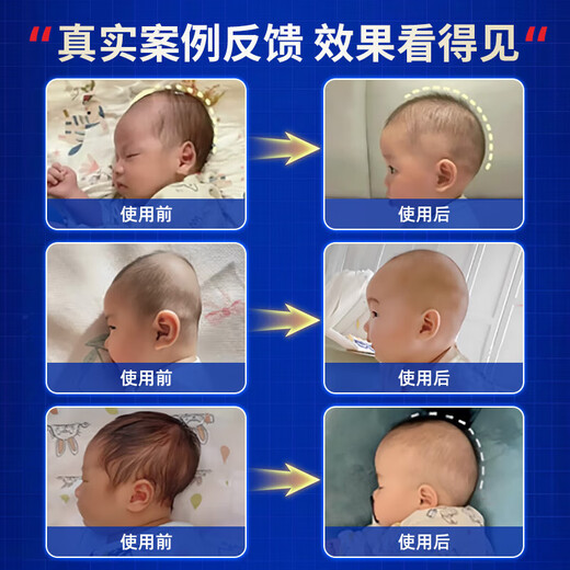 Bei Chuzhong shaped pillow for babies 0-6 months sleeping with round heads 0-1 years old baby pillow to correct lopsided head shape newborn child pillow white and blue 0-6 months 10A antibacterial maternal and infant grade 0-2-3 years old baby head shape correction adjustable drawstring summer machine washable medical