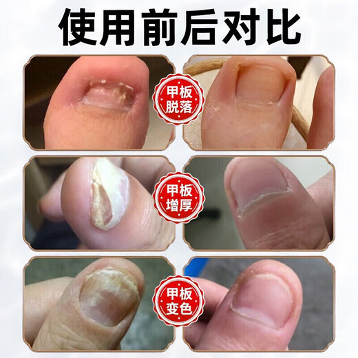 DR.JOINTNA Pharmaceutical onychomycosis special nail fungal infection denaturation and bad nail yellowing and thickening special effect nail artifact liquid phoenix flower