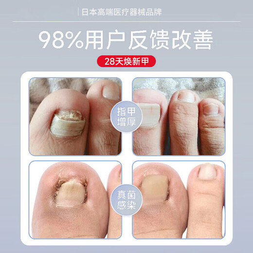 Japanese onychomycosis 100% effective special medicine. Severe onychomycosis imported fungal infection, bad nails turn yellow and thicken. Japanese special onychomycosis liquid 1 box, mildly suitable. No. 1 medicine onychomycosis 100% effective.