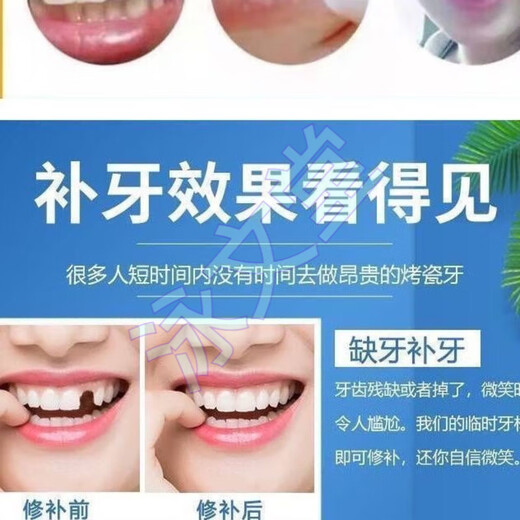 奇力康补牙材料永久医用补牙齿神器材料永久自己在家补牙材料临时补牙缝 967倍效【补15颗牙】爆丨款坚固不掉