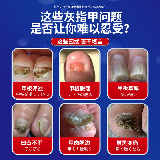 Higashida Japanese onychomycosis 100% genuine special fungal infection onychomycosis thickening, yellowing, thickening and empty 2 boxes suitable for moderate onychomycosis