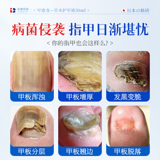 Xizi onychomycosis special effect root cream is specially used to treat nail fungal infection, remove the nail, make it yellow, thicken and thicken the antibacterial liquid.