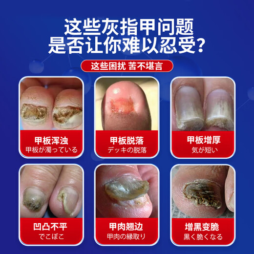 Miyamoto's onychomycosis 100% effective special medicine for severe onychomycosis fungal infection, nail removal, thickening, bad nail cream, antibacterial liquid 1 box, onychomycosis cream, No. 1 onychomycosis special effect