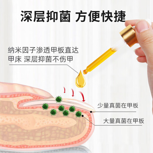 Yunnan Herbal Impatiens for Onychomycosis Antibacterial Onychomycosis Liquid Thickening, Yellowing and Empty Onychomycosis Special Effect Kit