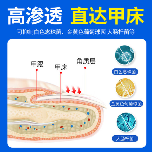 Correct impatiens onychomycosis antibacterial liquid, thick nails, bad nails, empty nails, yellowing, atrophy, discoloration, thickening and turbidity, fungal infection, impatiens onychomycosis antibacterial liquid 1 bottle